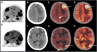 Tumor microenvironment and fibroblast activation protein inhibitor (FAPI) PET: developments toward brain imaging